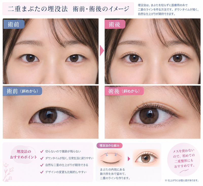 埋没法の術前・術後のイメージ画像